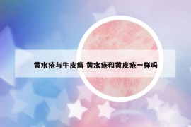 黄水疮与牛皮癣 黄水疮和黄皮疮一样吗
