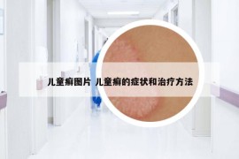 儿童癣图片 儿童癣的症状和治疗方法