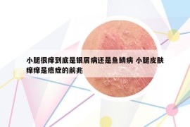 小腿很痒到底是银屑病还是鱼鳞病 小腿皮肤痒痒是癌症的前兆