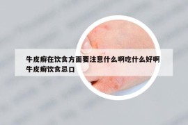 牛皮癣在饮食方面要注意什么啊吃什么好啊 牛皮癣饮食忌口