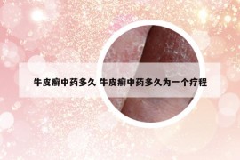 牛皮癣中药多久 牛皮癣中药多久为一个疗程