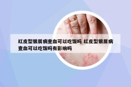 红皮型银屑病查血可以吃饭吗 红皮型银屑病查血可以吃饭吗有影响吗
