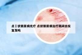 点滳状银屑病光疗 点状银屑病治疗期间会反复发吗