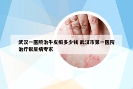武汉一医院治牛皮癣多少钱 武汉市第一医院治疗银屑病专家