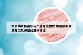 银屑病皮损面积与严重程度指数 银屑病的临床分型及各型的皮损特征