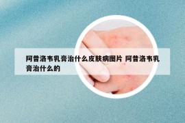 阿昔洛韦乳膏治什么皮肤病图片 阿昔洛韦乳膏治什么的