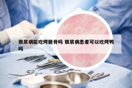 银屑病能吃烤脆骨吗 银屑病患者可以吃烤鸭吗