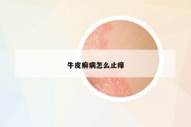 牛皮癣病怎么止痒