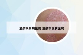 酒泉银屑病医院 酒泉市皮肤医院