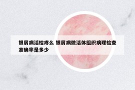 银屑病活检疼么 银屑病做活体组织病理检查准确率是多少