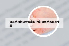 银屑病如何区分轻度和中度 银屑病怎么算中度