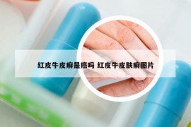 红皮牛皮癣是癌吗 红皮牛皮肤癣图片
