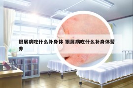 银屑病吃什么补身体 银屑病吃什么补身体营养