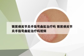 银屑病关节炎手指弯曲能治疗吗 银屑病关节炎手指弯曲能治疗吗视频