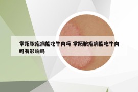 掌跖脓疱病能吃牛肉吗 掌跖脓疱病能吃牛肉吗有影响吗