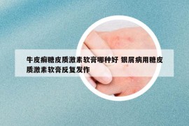 牛皮癣糖皮质激素软膏哪种好 银屑病用糖皮质激素软膏反复发作