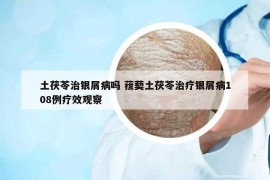 土茯苓治银屑病吗 菝葜土茯苓治疗银屑病108例疗效观察