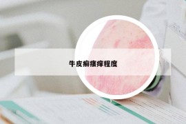 牛皮癣瘙痒程度
