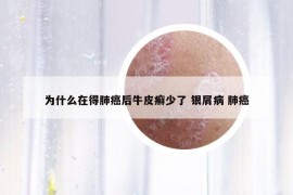 为什么在得肺癌后牛皮癣少了 银屑病 肺癌