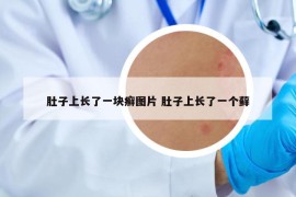 肚子上长了一块癣图片 肚子上长了一个藓