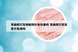 荨麻疹打生物制剂针有效果吗 荨麻疹打抗生素针有用吗