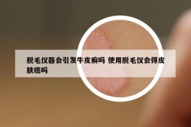 脱毛仪器会引发牛皮癣吗 使用脱毛仪会得皮肤癌吗