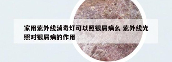 家用紫外线消毒灯可以照银屑病么 紫外线光照对银屑病的作用