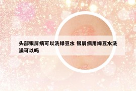 头部银屑病可以洗绿豆水 银屑病用绿豆水洗澡可以吗