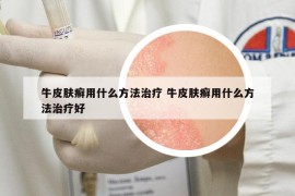 牛皮肤癣用什么方法治疗 牛皮肤癣用什么方法治疗好