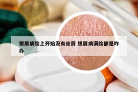银屑病脸上开始没有皮屑 银屑病满脸都是咋办