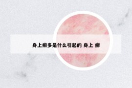 身上癣多是什么引起的 身上 癣