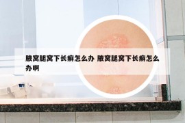 腋窝腿窝下长癣怎么办 腋窝腿窝下长癣怎么办啊