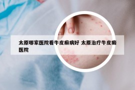 太原哪家医院看牛皮癣病好 太原治疗牛皮癜医院