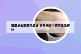 银屑病去那医院最好 银屑病哪个医院能治得好