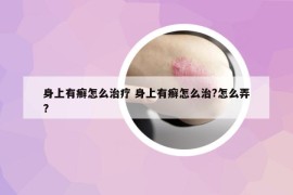 身上有癣怎么治疗 身上有癣怎么治?怎么弄?