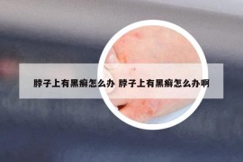 脖子上有黑癣怎么办 脖子上有黑癣怎么办啊