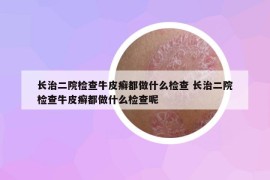长治二院检查牛皮癣都做什么检查 长治二院检查牛皮癣都做什么检查呢