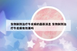 生物制剂治疗牛皮癣的最新消息 生物制剂治疗牛皮癣有效果吗