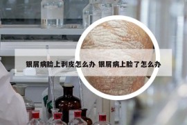银屑病脸上剥皮怎么办 银屑病上脸了怎么办