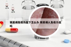 银屑病免疫力低下怎么办 银屑病人免疫力低吗