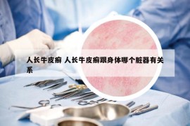 人长牛皮癣 人长牛皮癣跟身体哪个脏器有关系
