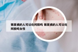 银屑病的人可以吃阿胶吗 银屑病的人可以吃阿胶吗女性