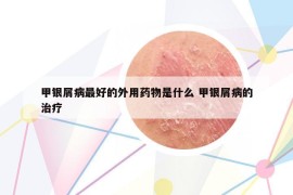 甲银屑病最好的外用药物是什么 甲银屑病的治疗