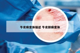 牛皮癣查体描述 牛皮肤癣查体