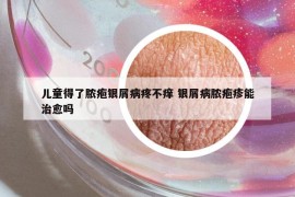 儿童得了脓疱银屑病疼不痒 银屑病脓疱疹能治愈吗