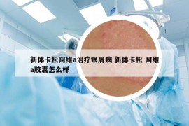 新体卡松阿维a治疗银屑病 新体卡松 阿维a胶囊怎么样