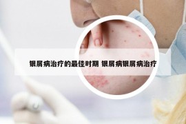 银屑病治疗的最佳时期 银屑病银屑病治疗