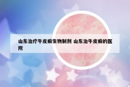 山东治疗牛皮癣生物制剂 山东治牛皮癣的医院