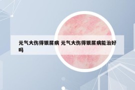 元气大伤得银屑病 元气大伤得银屑病能治好吗