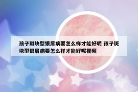 孩子斑块型银屑病要怎么样才能好呢 孩子斑块型银屑病要怎么样才能好呢视频